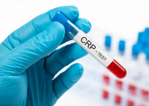 CRP (C-Reactive Protein) test tube for Latex Immuno Turbidimetric Assay by Nagase, held by a gloved hand in a laboratory setting with blurred test tubes in the background.