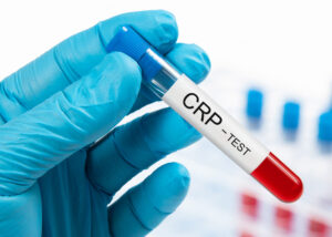 CRP (C-Reactive Protein) test tube for Latex Immuno Turbidimetric Assay by Nagase, held by a gloved hand in a laboratory setting with blurred test tubes in the background.